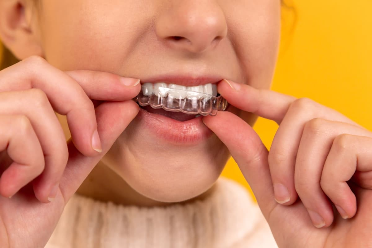 Aligneurs orthodontiques invisibles